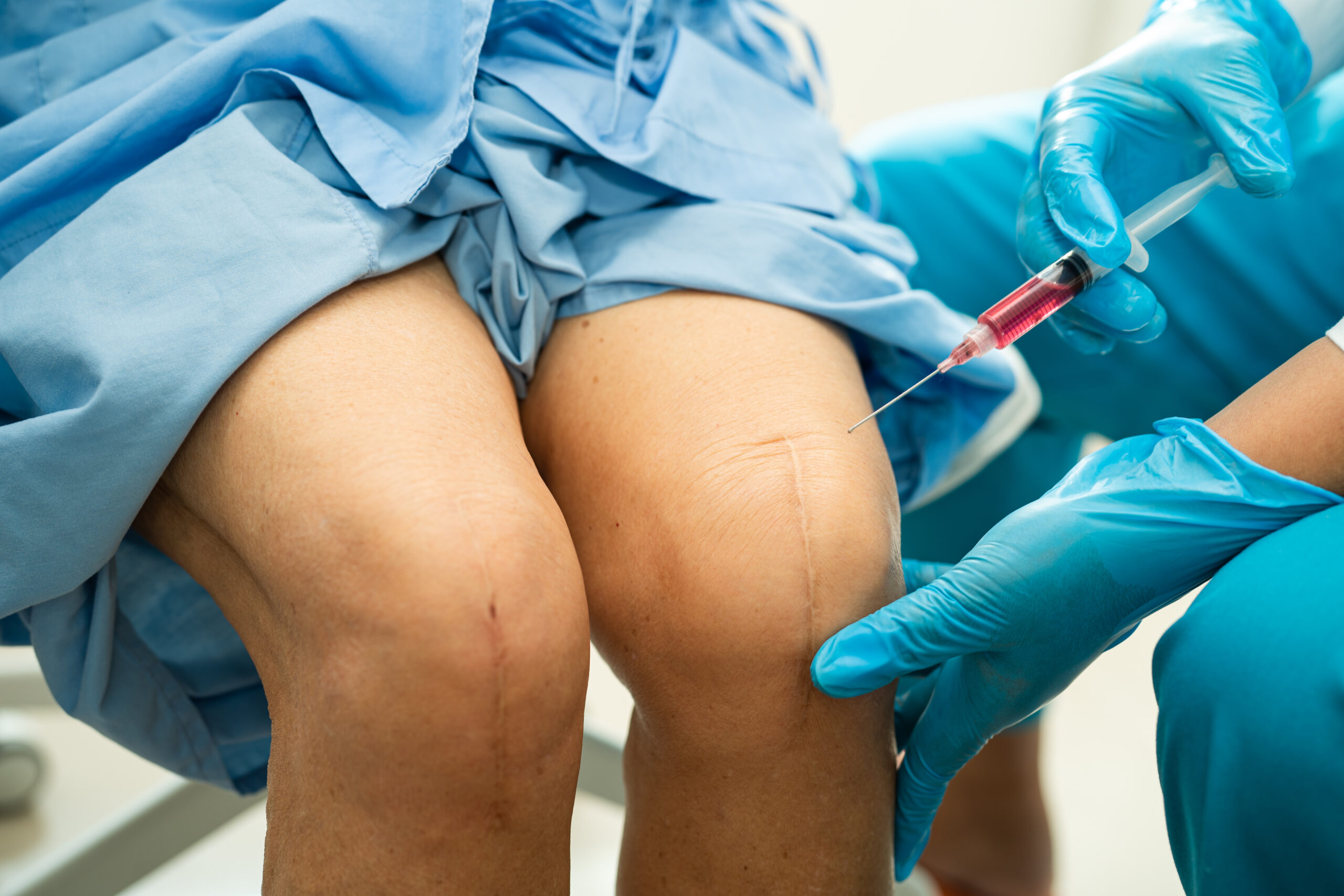 Intra-Articular Injections