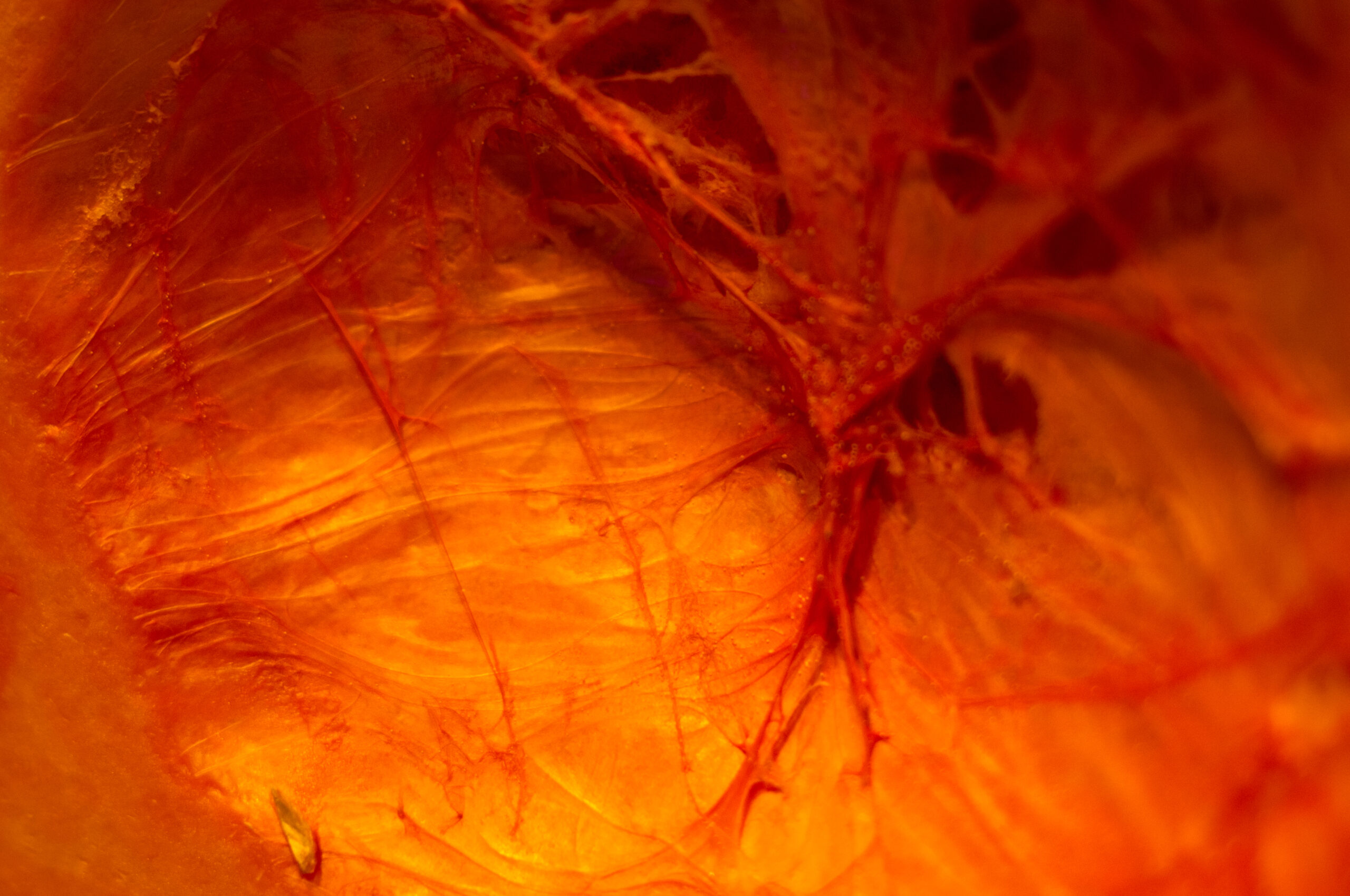 Nerve Root Block